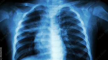 Study shows the high rates of subclinical TB infections in PLWHA 